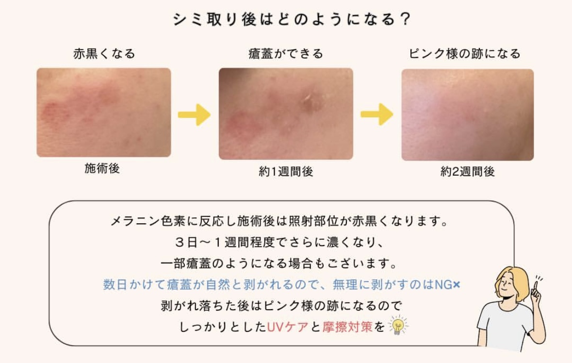 レーザーでのシミ取り後の経過をまとめた画像。施術後は照射部位が赤黒くなり、3日～1週間程度で更に濃くなり、一部かさぶたのようになる場合もある。数日かけてかさぶたが自然と剥がれるので剥がすのはNG、剥がれ落ちたらピンク色の跡になるのでUVケアと摩擦対策を欠かさないこと、が写真とテキストで表されている。