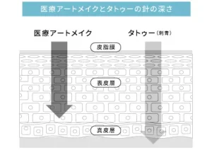 医療アートメイクとタトゥーの違いの図解イラスト