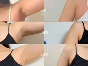 ワキガ・多汗症治療のミラドライ、経過画像