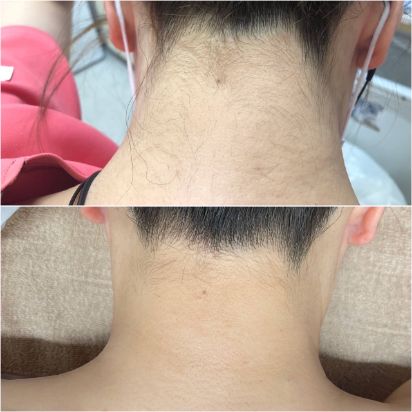 医療脱毛症例画像　施術｜医療脱毛（1～3回） 価格｜6,800円(税込7,480円)～20,400円(税込22,440円) 副作用（リスク）｜発赤、熱感、痒み、痛み、乾燥、硬毛化