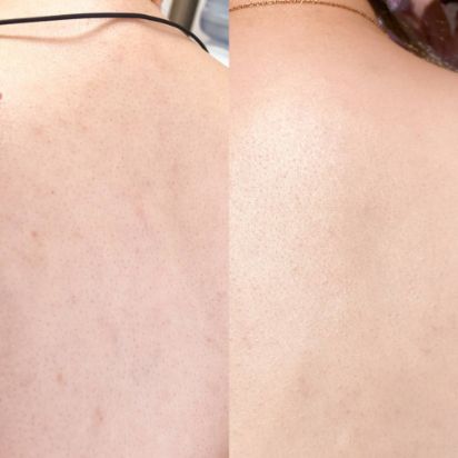 医療脱毛症例画像　施術｜医療脱毛（1～3回） 価格｜14,800円(税込16,280円)～44,400円(税込48,840円) 副作用（リスク）｜発赤、熱感、痒み、痛み、乾燥、硬毛化