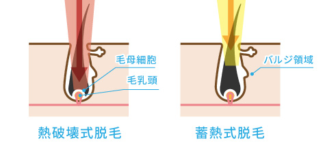 熱破壊式脱毛と蓄熱式脱毛の違いの図解