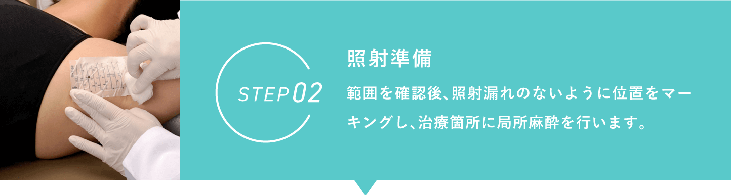 ワキガ・多汗症治療 ミラドライ STEP2 照射範囲 範囲を確認後、照射漏れのないように位置をマーキングし、治療箇所に局所麻酔を行います。