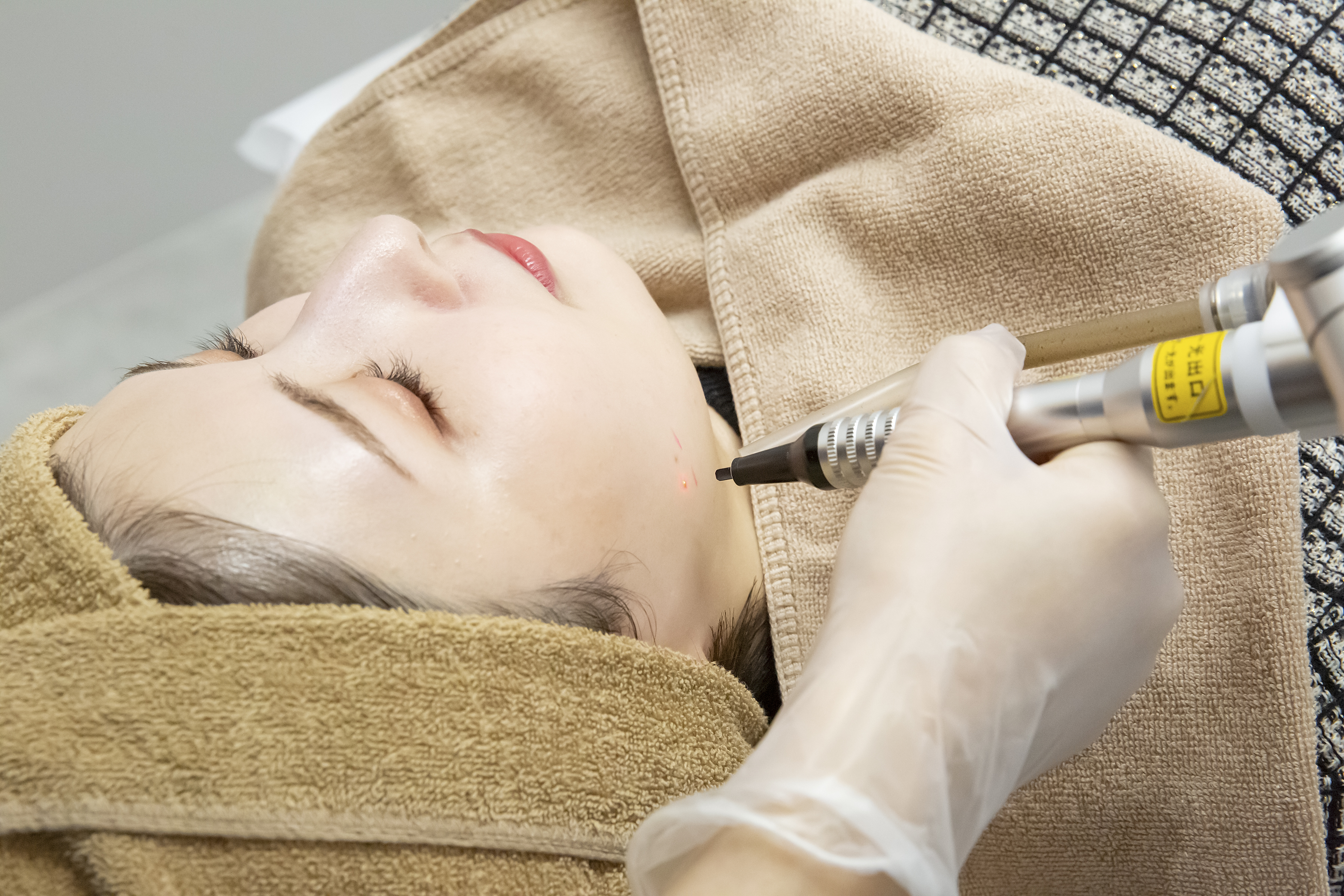 ミセルクリニック岸和田院（ただおかメディカルクリニック併設美容皮膚科）ほくろ・イボ除去（炭酸ガスレーザー）の施術画像