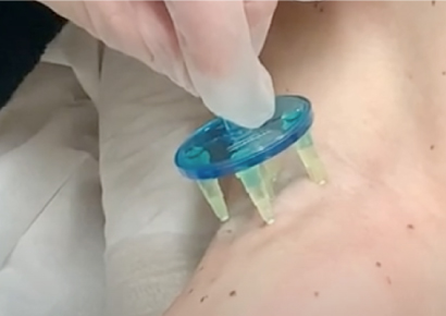 ただおかメディカルクリニック（美容皮膚科）のワキガ・多汗症治療「ミラドライ」の痛みが少ない麻酔