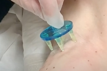 STEP4 ただおかメディカルクリニック（美容皮膚科）のミラドライ治療の流れ：麻酔